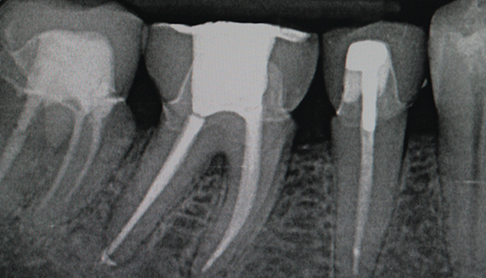 Endodontie / Wurzelbehandlung